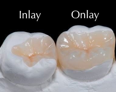 inlay-onlay.jpg